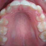 andr m 0002 Occlusal Photo of Maxillary Dentition