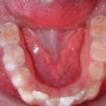 andr m 0003 Occlusal Photo of Mandibular Dentition