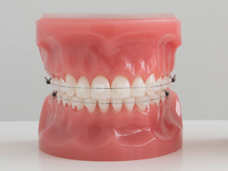 aparato ortodoncia con brackets ceramicos