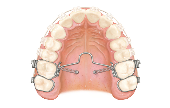 dispositivos de anclaje temporal ortodoncia mg