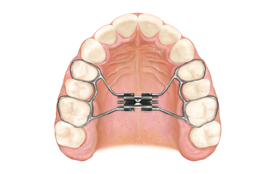 expansor palatino ortodoncia mg