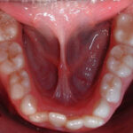 jose m 0003 Occlusal Photo of Mandibular Dentition