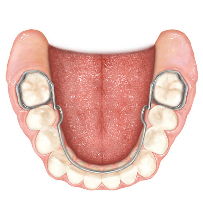 lingual holding arch ortodoncia mg bg