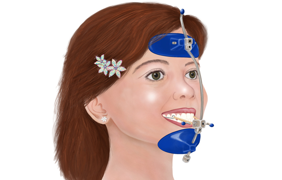 mascara de protraccion ortodoncia mg