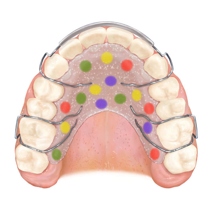 retenedor ortodoncia mg