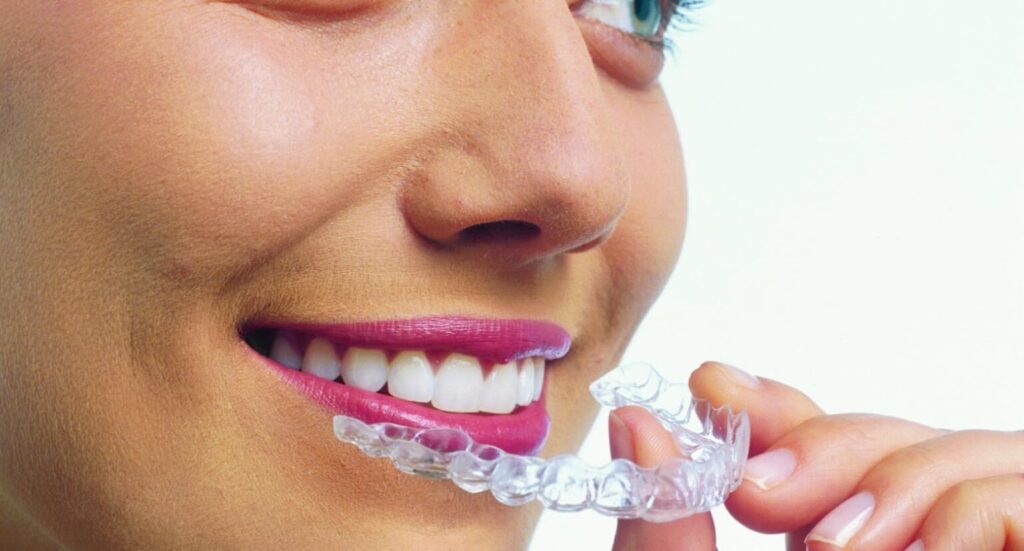 invisalign