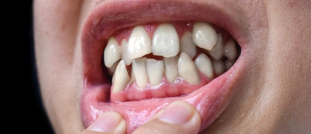 Protegido: Problemas ortodóncicos más comunes