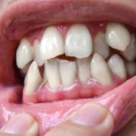 Problemas ortodóncicos más comunes - ortodoncia mg en vigo